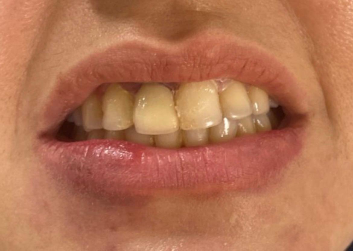 After Treatment - Front Tooth Gap & Dental Implant Restoration