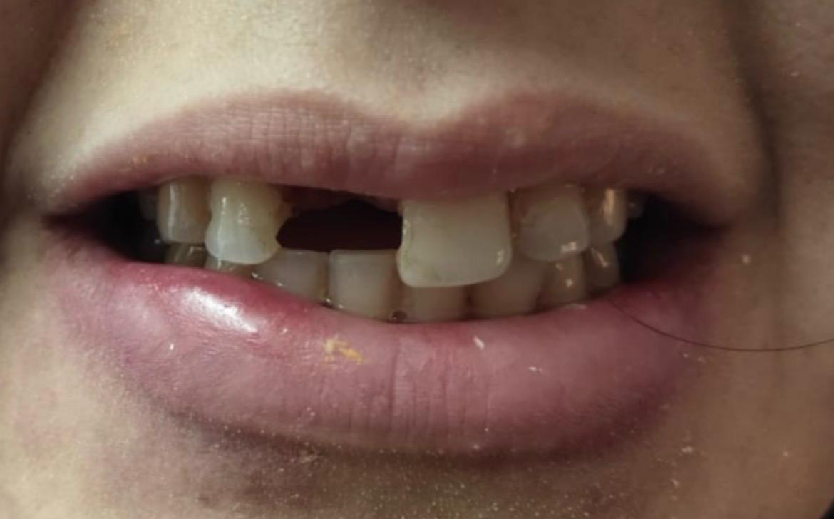 Before Treatment - Front Tooth Gap & Dental Implant Restoration