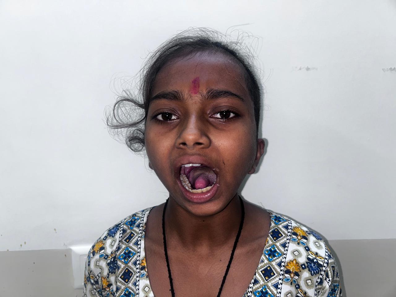 After Treatment - Pediatric Mandibular Posture & Oral Alignment
