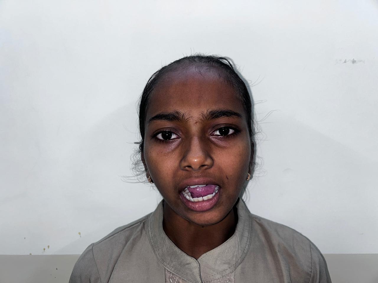 Before Treatment - Pediatric Mandibular Posture & Oral Alignment