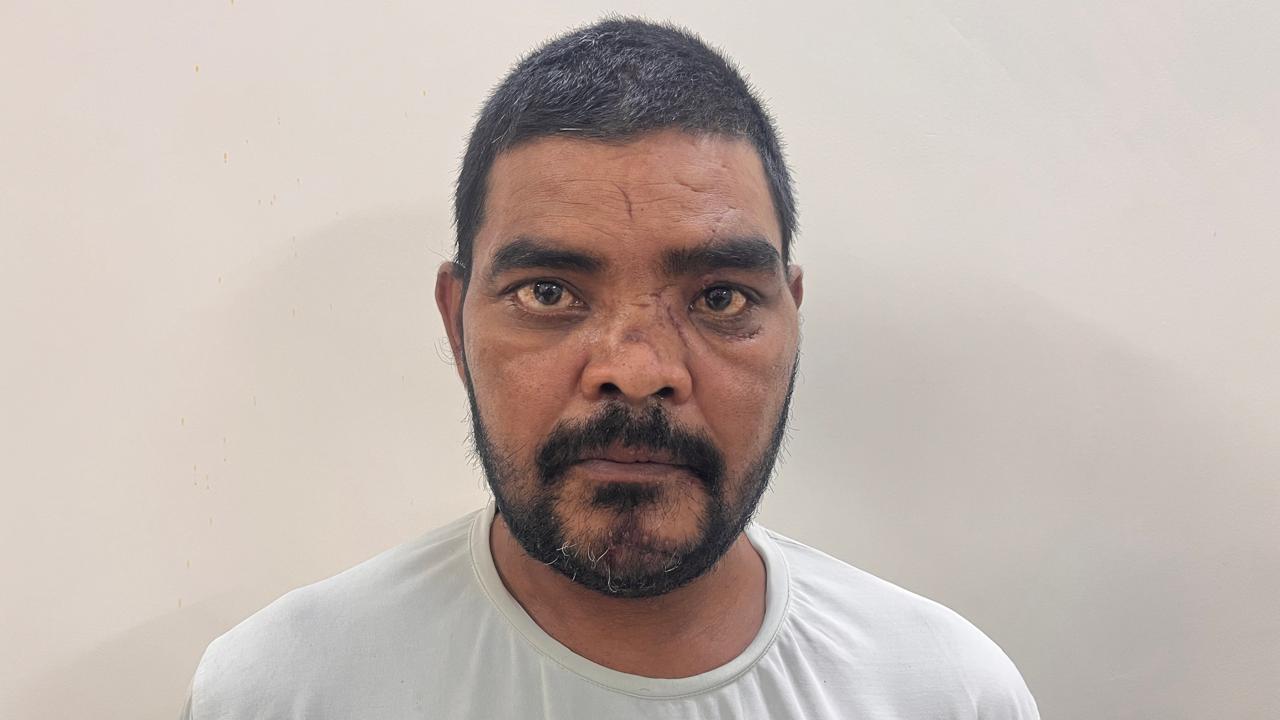 After Treatment - Facial Trauma & Soft Tissue Reconstruction