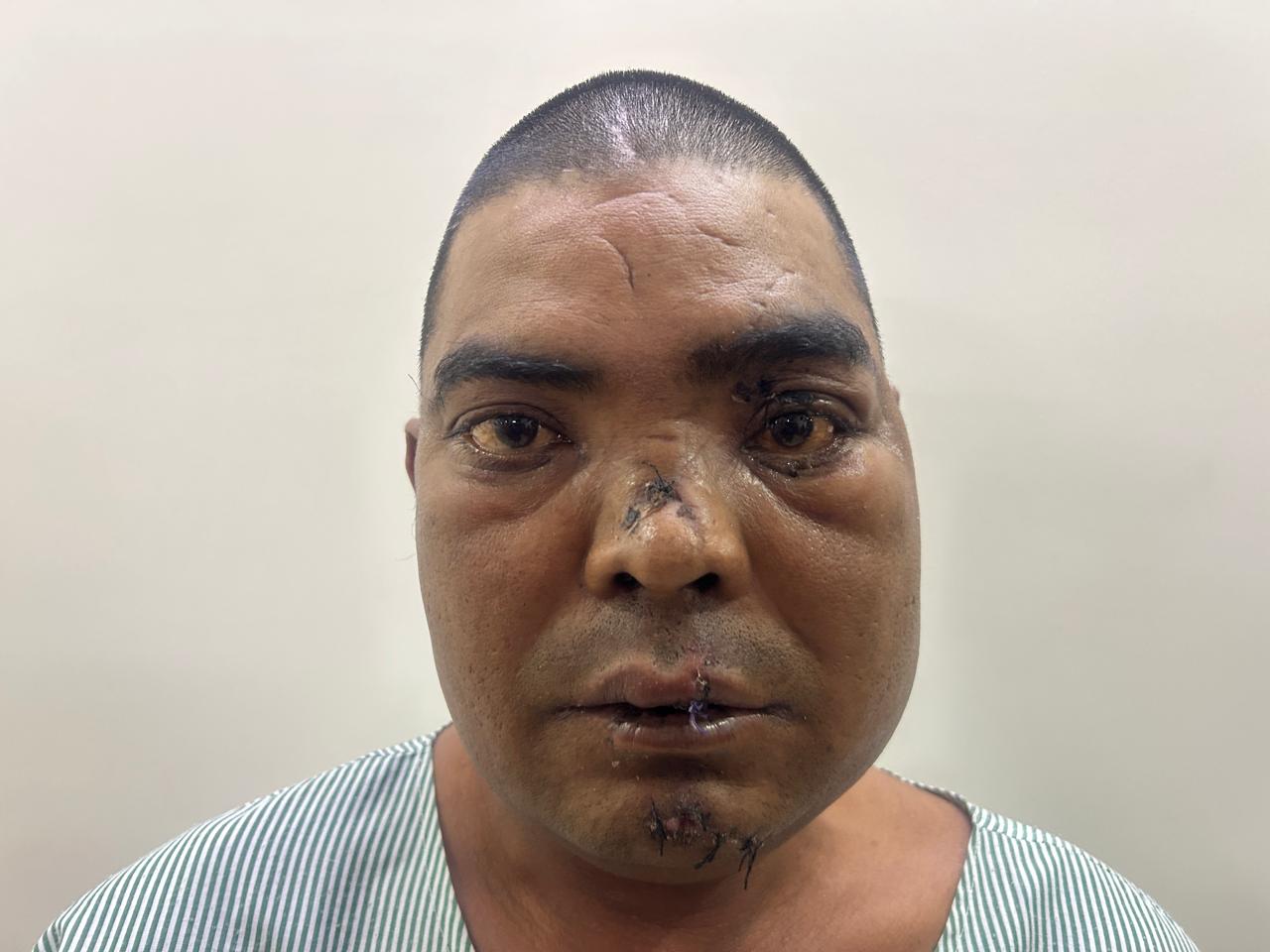 Before Treatment - Facial Trauma & Soft Tissue Reconstruction