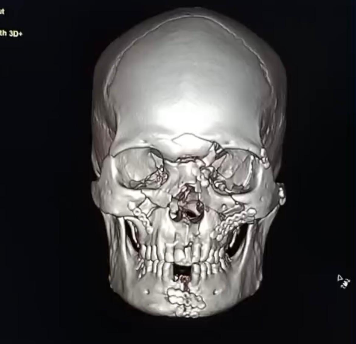 After Treatment - 3D Surgical Fixation of Panfacial Fractures