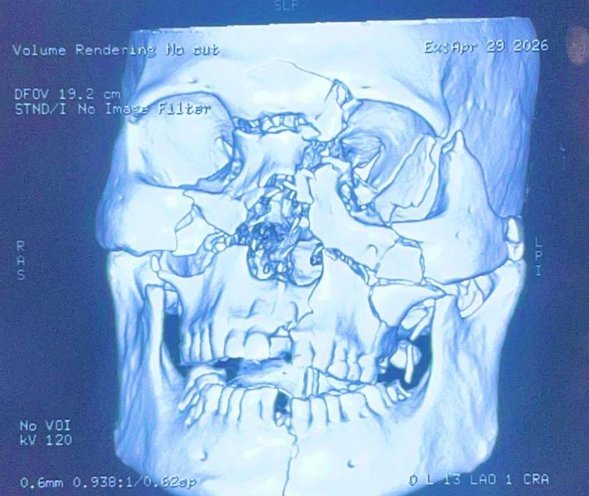 Before Treatment - 3D Surgical Fixation of Panfacial Fractures