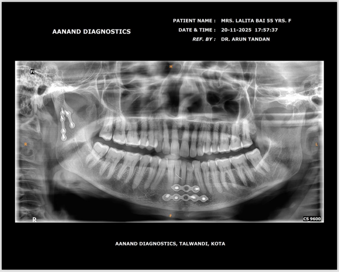 After Treatment - Mandibular Fracture Fixation with Titanium Plates