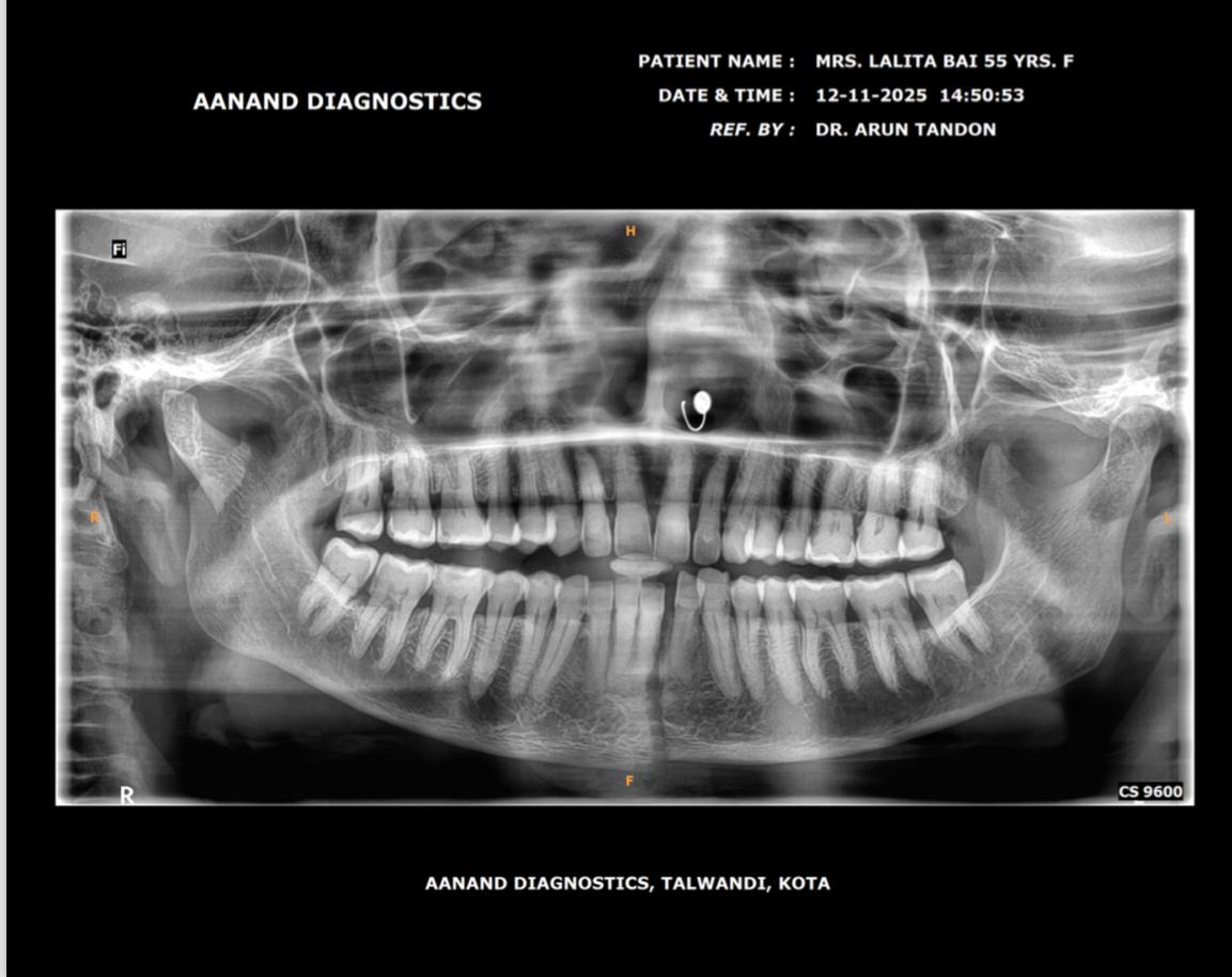 Before Treatment - Mandibular Fracture Fixation with Titanium Plates