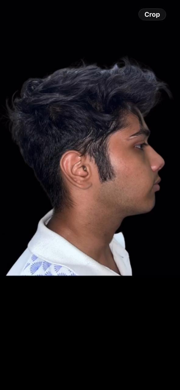After Treatment - Profile Correction & Mandibular Advancement