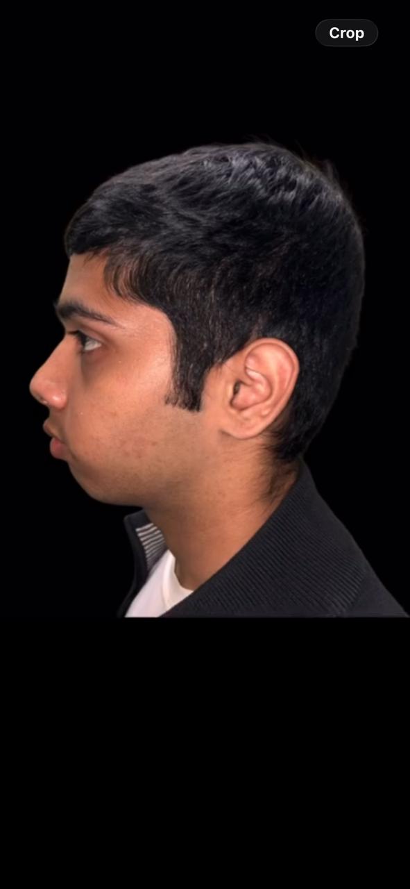 Before Treatment - Profile Correction & Mandibular Advancement