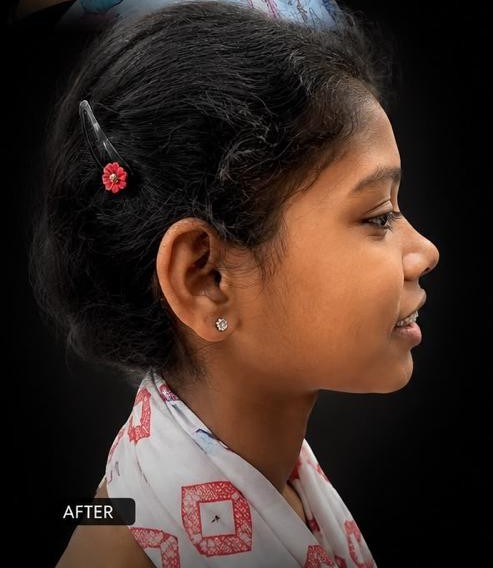 After Treatment - Forward-Placed Front Teeth Correction