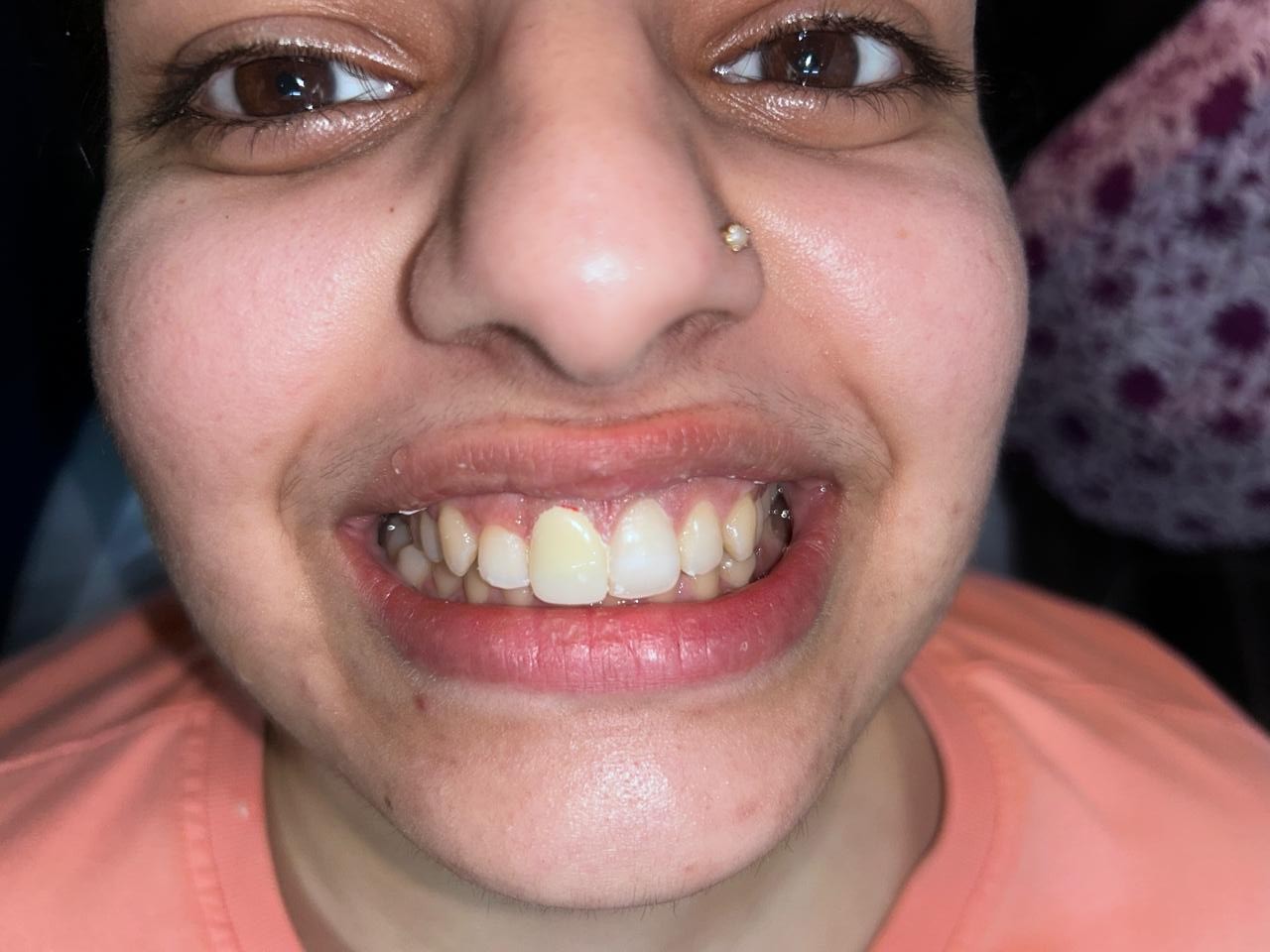 After Treatment - Aesthetic Correction of Fractured & Subluxated Anterior Tooth