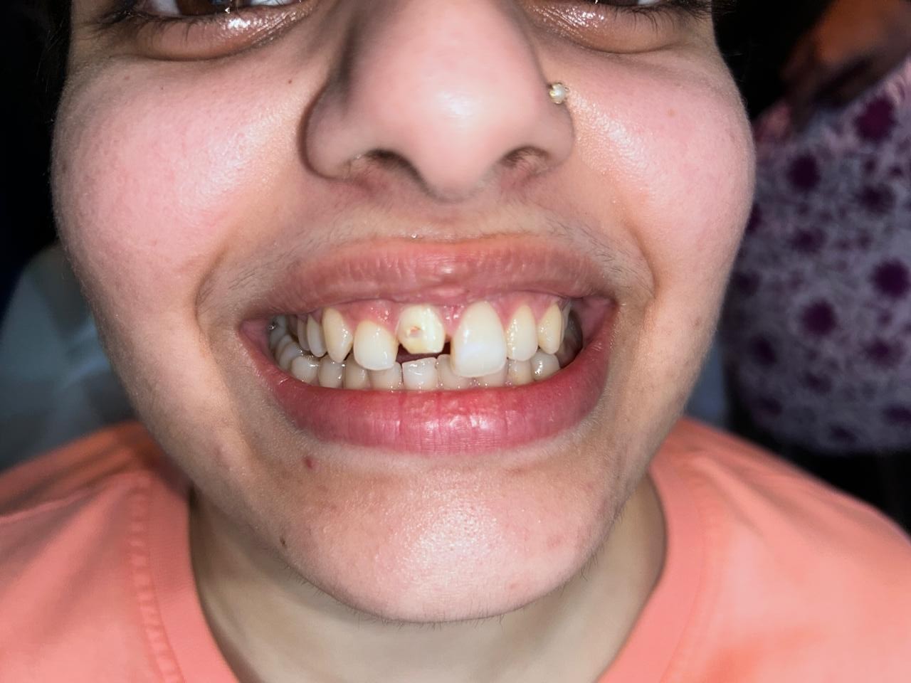 Before Treatment - Aesthetic Correction of Fractured & Subluxated Anterior Tooth