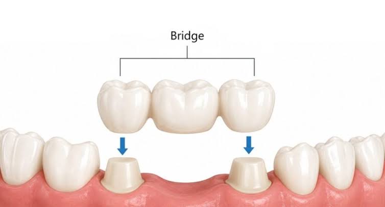 Crowns and Bridges