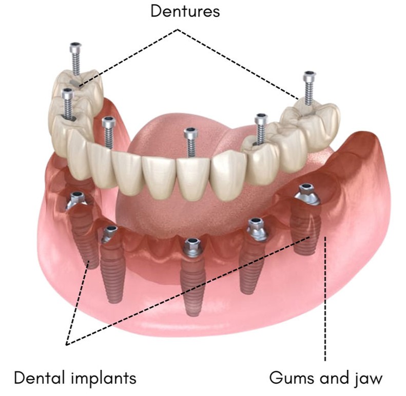 Permanent Dental Implants
