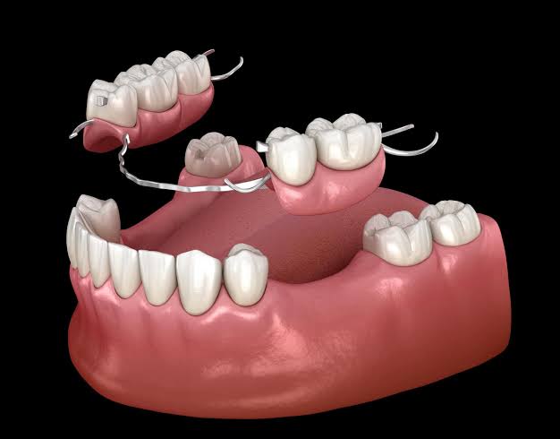 Complete & Partial Dentures