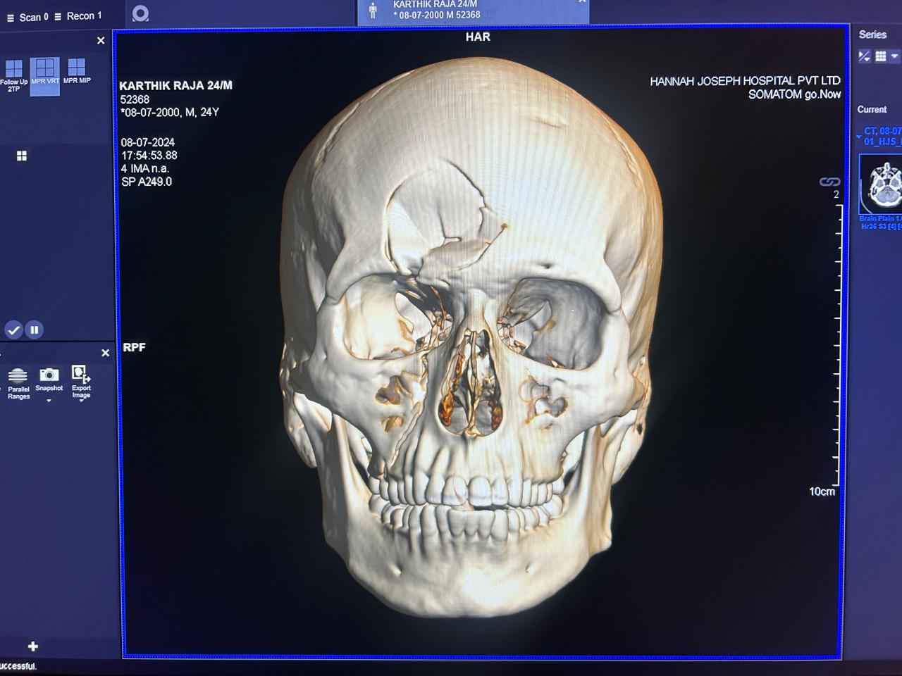 Cranio-Facial Trauma Surgery