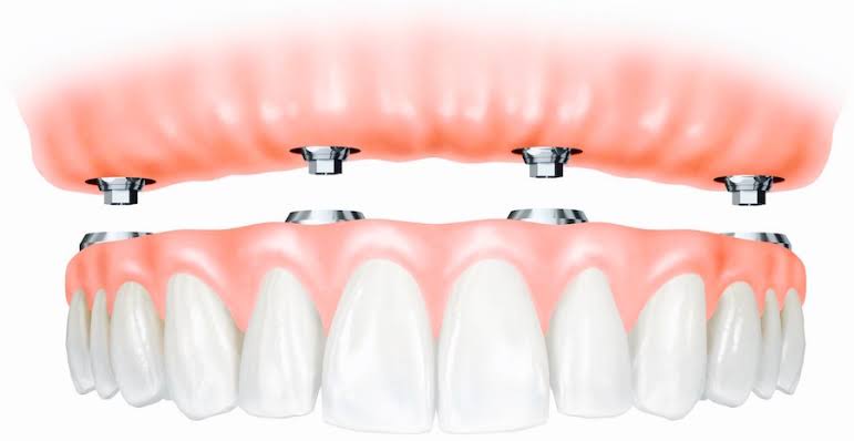 Fixed & Implant Dentures