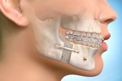 Jaw Correction & Surgery