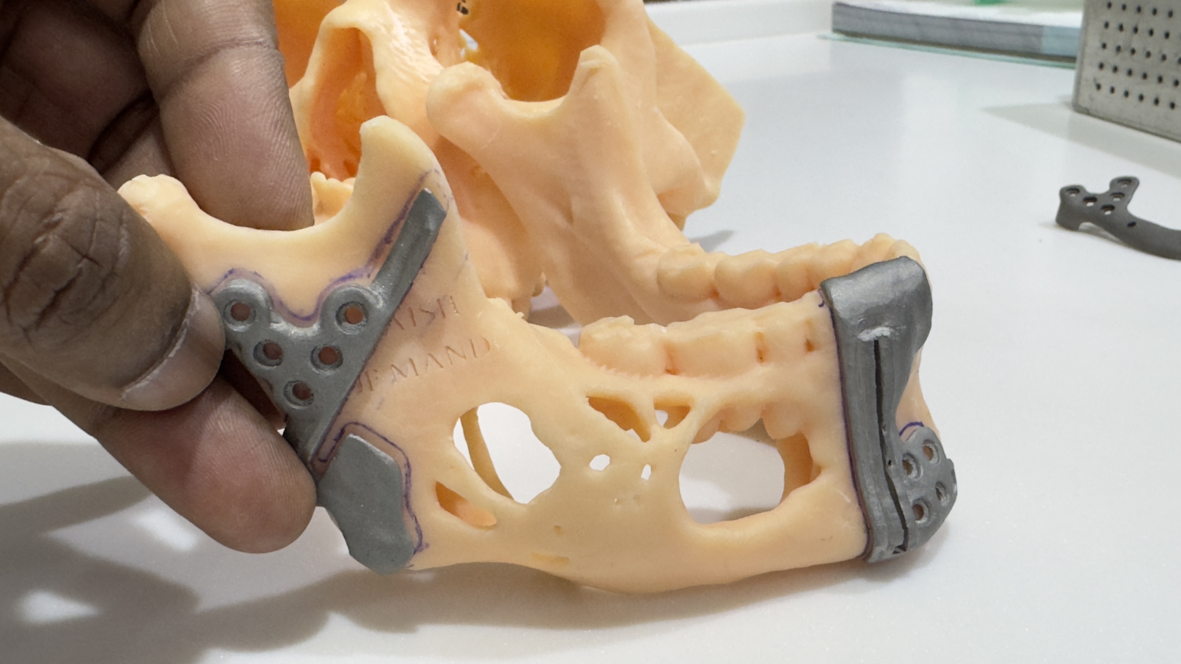Total Joint Replacement Surgeries