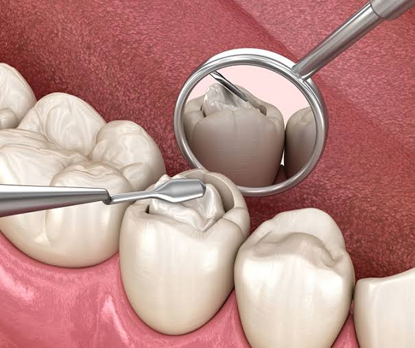 Tooth Fillings & Cavity Repair